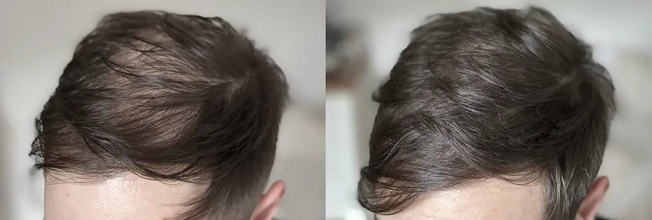 Hair Density after Hair Transplant