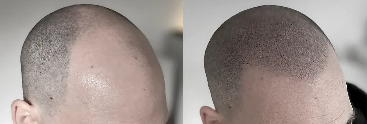 Difined Hairline with broken finish